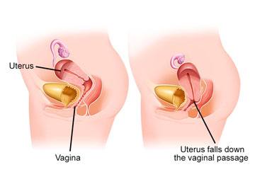 Uterine Prolapse doctor in Meerut