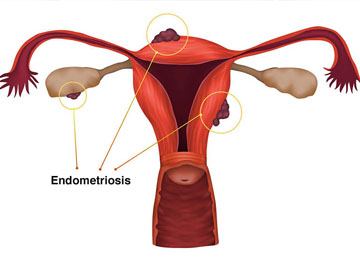 Endometriosis doctor in Meerut